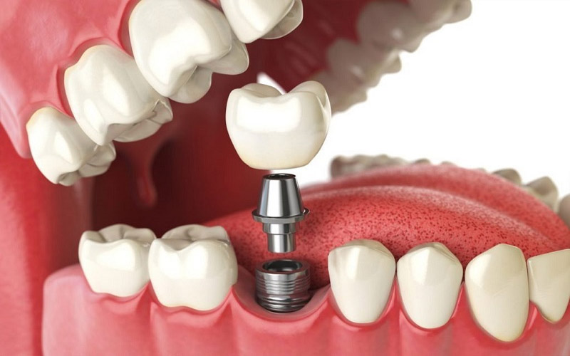 Cách trồng răng sứ bằng trụ Implant khá phức tạp