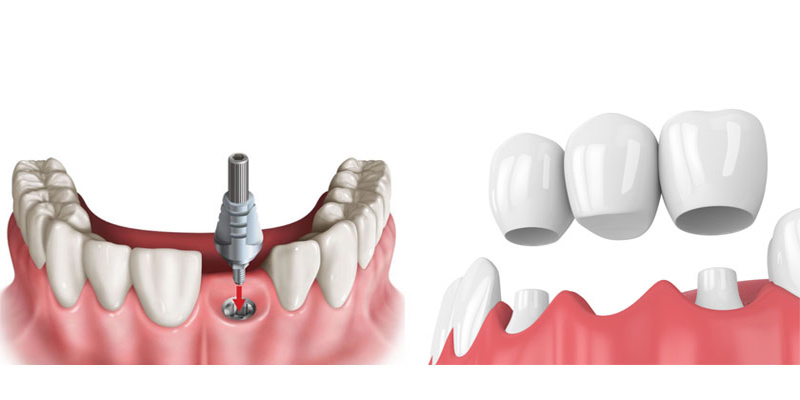 Trồng răng sứ là một phương pháp phổ biến trong nha khoa thẩm mỹ