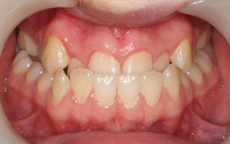 Người có khớp cắn sai lệch nghiêm trọng không nên trồng răng sứ