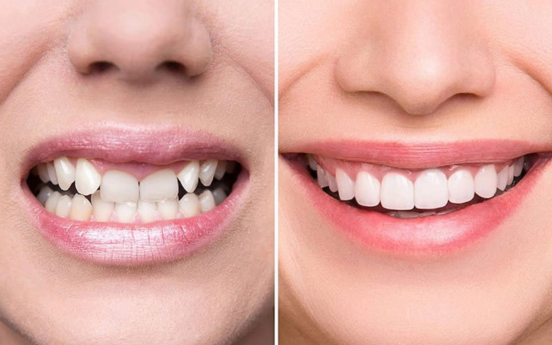Dịch vụ này giúp bạn sở hữu hàm răng đều đẹp hơn