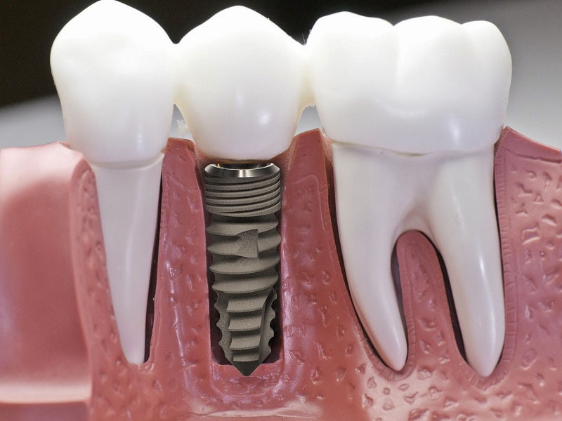 Cấy ghép Implant có tuổi thọ lâu bền, bảo vệ răng miệng tốt nhất