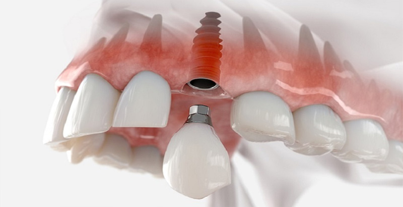 Cấy ghép Implant ngăn ngừa được tình trạng tiêu xương hàm