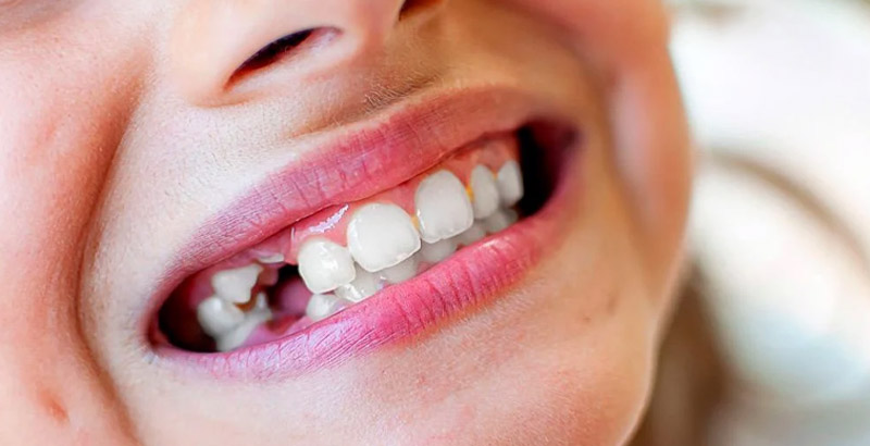 Mất răng gây ra nhiều ảnh hưởng đến khả năng ăn nhai, thẩm mỹ