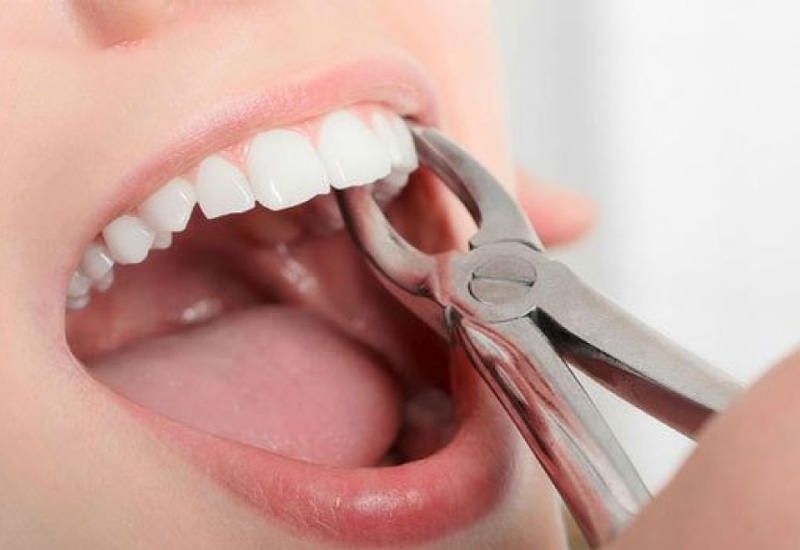 Nhổ răng không phục hình sẽ gây ra nhiều tác hại