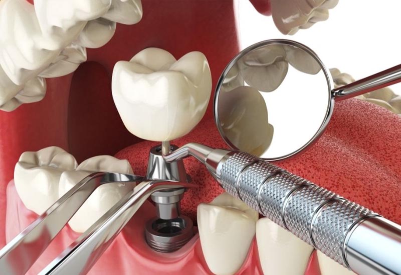 Sau khi nhổ răng bao lâu thì trồng implant được là thắc mắc của nhiều người