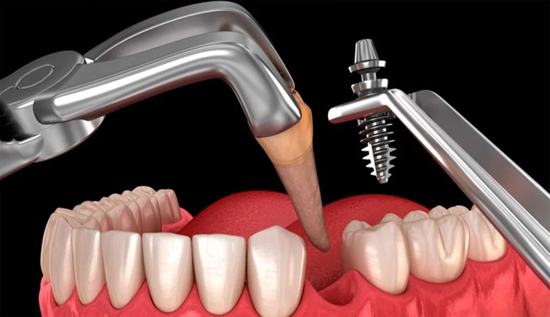 Cấy ghép Implant là phương pháp trồng răng hiện đại nhất hiện nay,