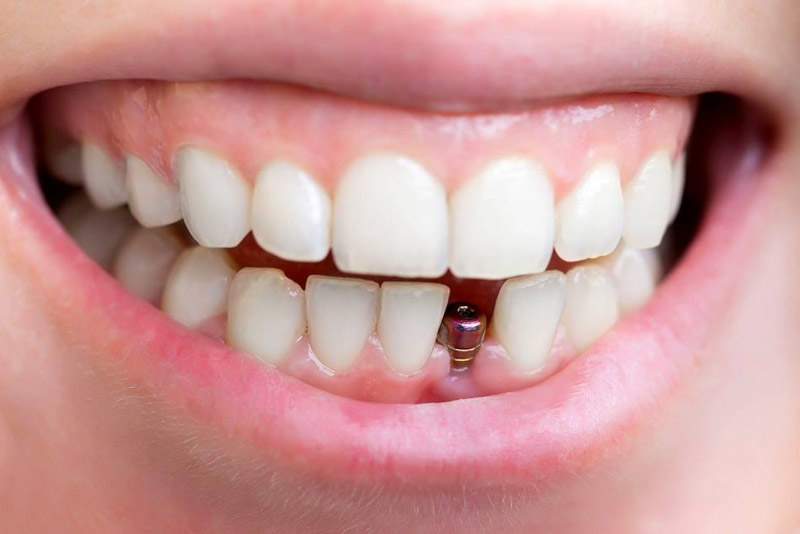 Trồng răng giả cố định gồm 5 bước chuẩn Y khoa