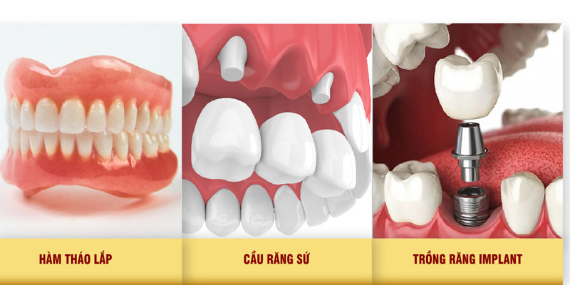 Mỗi phương pháp phục hình răng có ưu nhược điểm khác nhau