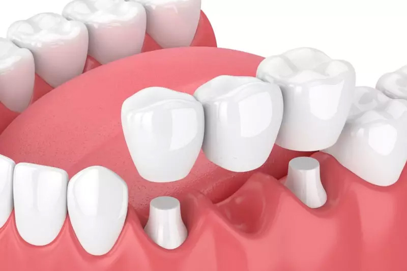 Trồng răng bắc cầu còn được gọi là làm cầu răng sứ