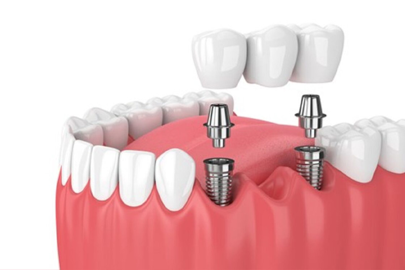 Bắc cầu Implant là sự kết hợp giữa làm cầu răng sứ và cấy ghép Implant