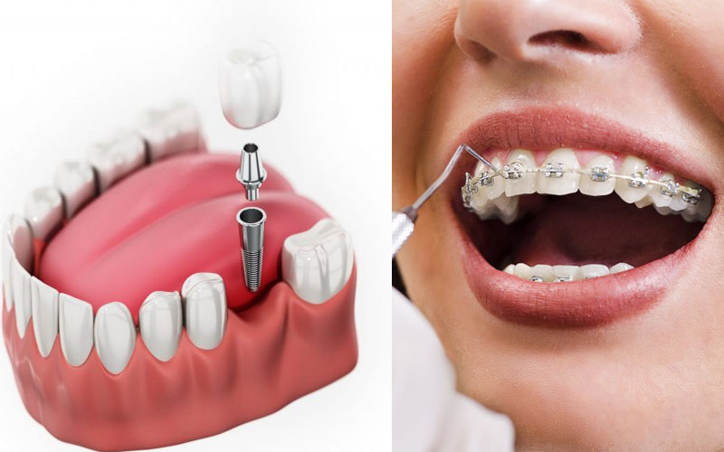 Trồng răng có niềng được không là thắc mắc của nhiều người