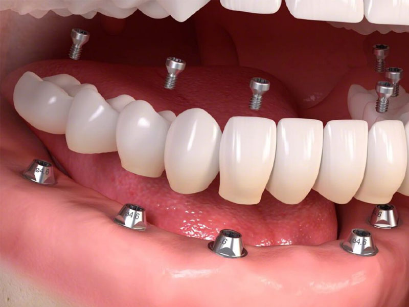 Trồng răng toàn hàm không thể thực hiện chỉnh nha sau đó