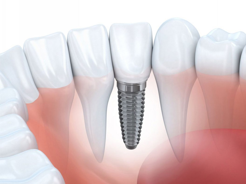Trồng răng Implant mất nhiều thời gian hơn các phương pháp khác