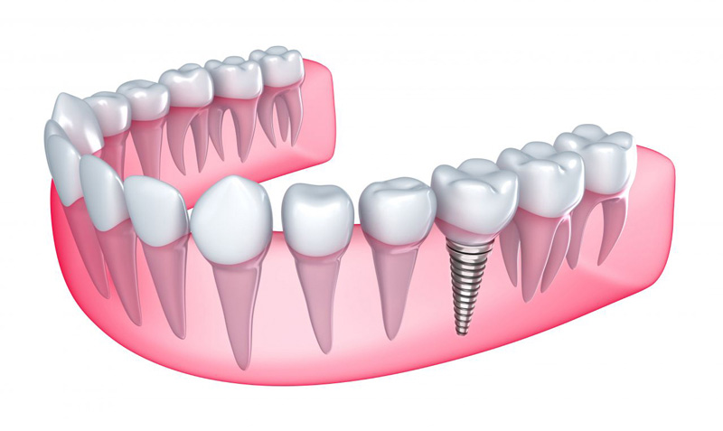Trồng răng Implant có thể mất 3 - 6 tháng để lành