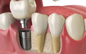 Trồng Răng Implant Bao Lâu Thì Lành, Làm Gì Để Lành Nhanh?