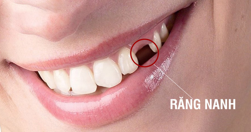 Mất răng nanh gây ra nhiều hệ quả, biến chứng