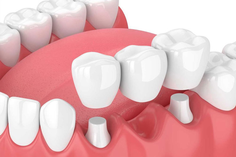 Có thể lựa chọn phương pháp cầu răng sứ để phục hình răng nanh