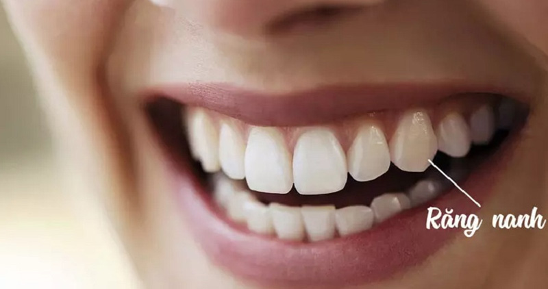 Chi phí trồng răng nanh phụ thuộc vào nhiều yếu tố