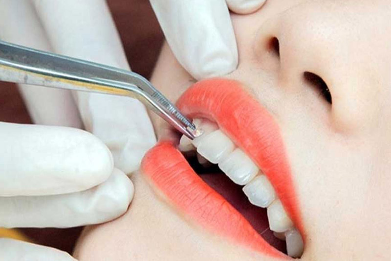 Quy trình phục hình răng nanh đúng chuẩn gồm 5 bước
