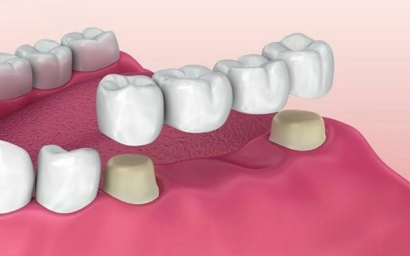 Bắc cầu răng sứ sử dụng 2 răng kế cạnh làm trụ