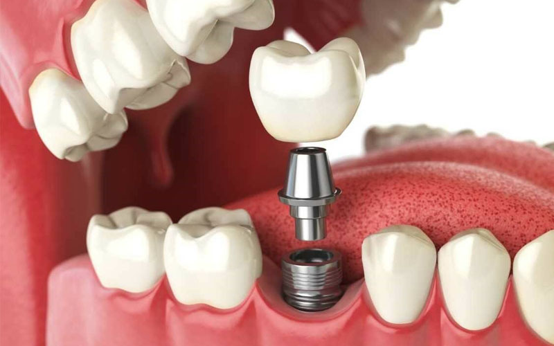 Trồng răng Titan bằng phương pháp cấy ghép gồm 4 bước