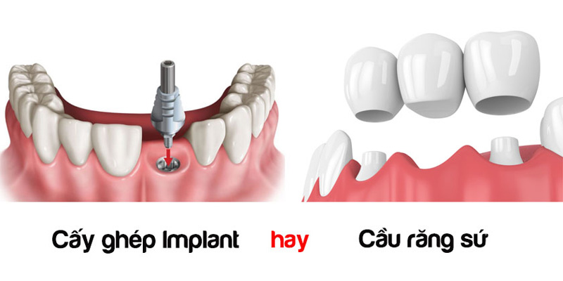Bắc cầu răng sứ và cấy ghép Implant là 2 phương pháp phục hình phổ biến