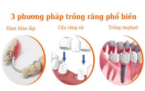 Trồng Răng Có Tốt Không? Quy Trình, Chi Phí, Lưu Ý Cần Nhớ