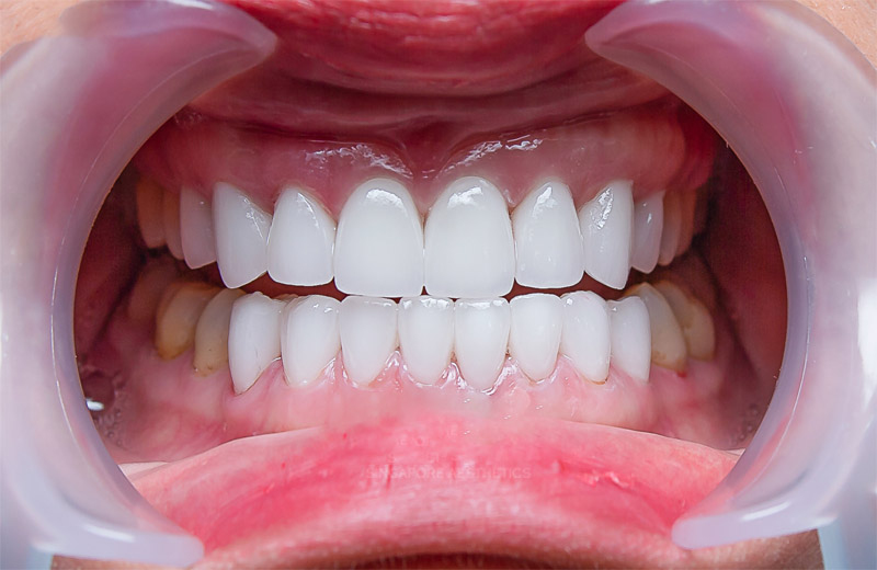 Bọc răng sứ cả hàm là kỹ thuật bọc sứ nhiều răng ở một hoặc cả hai hàm