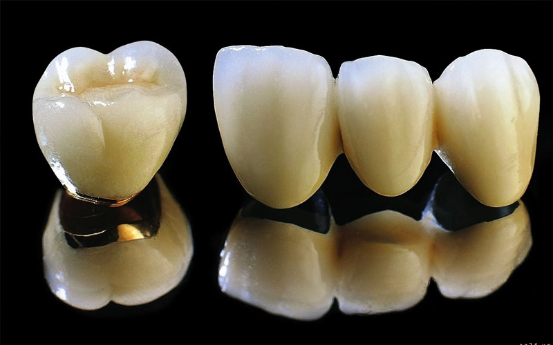 Răng sứ Titan là dòng mão sứ xuất hiện từ khá lâu đời