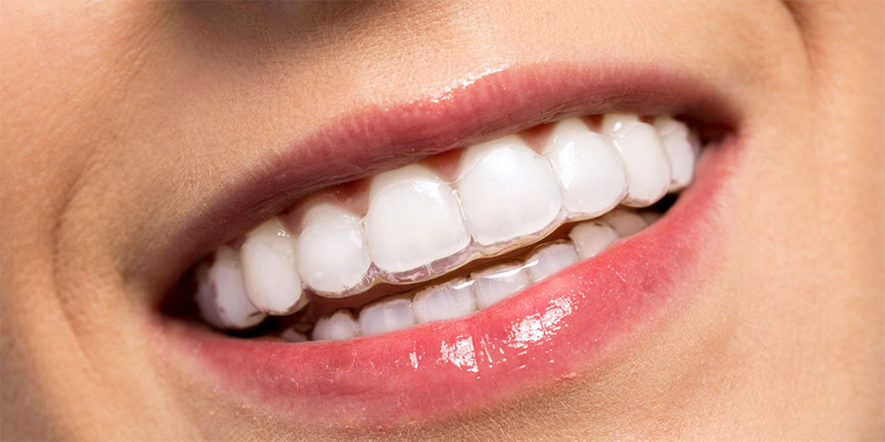 Niềng răng trong suốt có tính thẩm mỹ cao nên chi phí cũng cao hơn