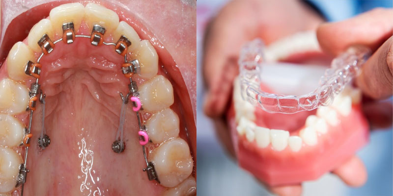 Niềng răng hàm dưới bằng khay trong suốt có chi phí cao hơn sử dụng mắc cài