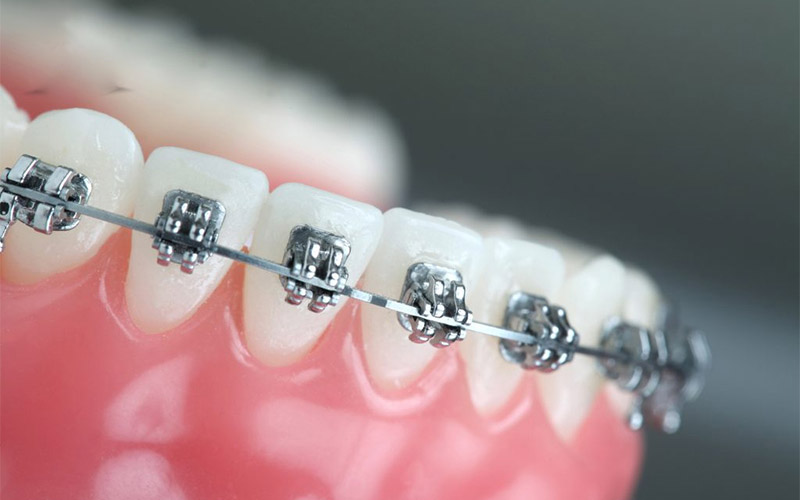 Niềng răng hàm dưới với mắc cài kim loại có chi phí tiết kiệm