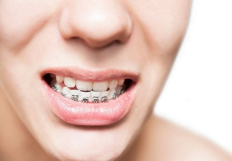 Chi phí niềng răng thay đổi dựa vào độ lệch lạc của răng