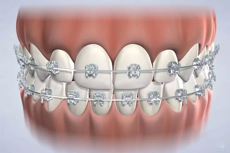Niềng răng mắc cài sứ dây trong có hiệu quả nắn chỉnh răng tốt hơn