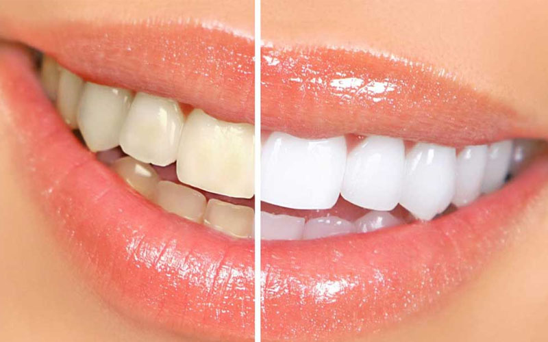 Tẩy trắng răng giúp cải thiện tình trạng ố vàng, xỉn màu trên răng