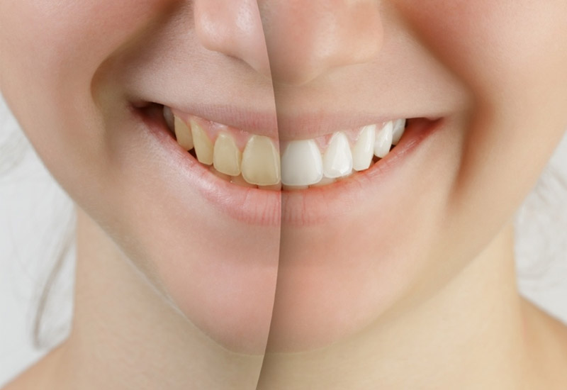 Mảng bám ố vàng được loại bỏ sau khi tẩy trắng răng