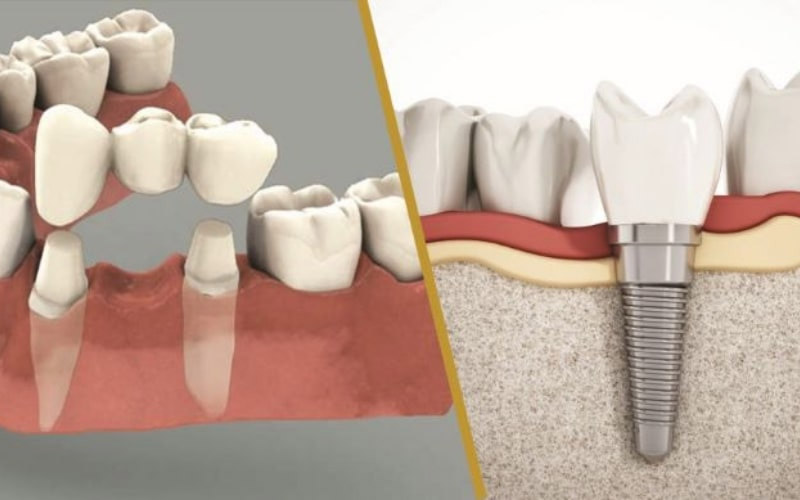 Trồng răng Implant và cầu răng sứ có nhiều điểm khác biệt