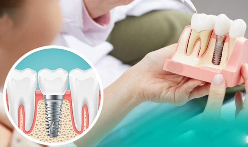 Trồng răng sứ vĩnh viễn là kỹ thuật phục hình răng bị gãy, sứt mẻ để lấy lại chức năng ăn nhai, thẩm mỹ