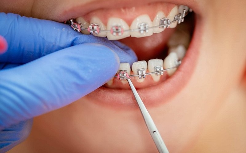Giai đoạn đầu lắp dụng cụ chỉnh răng, bác sĩ sẽ dùng dây cung kích thước nhỏ để gắn vào rãnh mắc cài 
