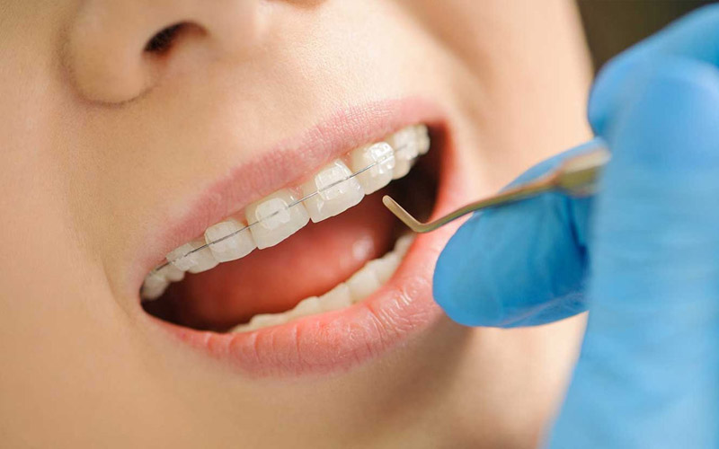 Niềng răng mắc cài sứ mang đến nhiều lợi ích cho khách hàng