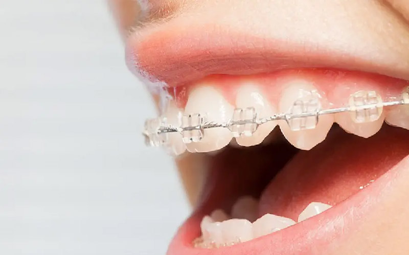 Chi phí niềng răng mắc cài bằng sứ cao hơn so với niềng răng bằng mắc cài kim loại