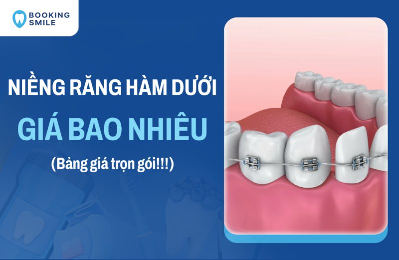 Niềng Răng Hàm Dưới Giá Bao Nhiêu? Bảng Giá Cập Nhật 2026