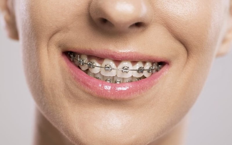 Chỉnh nha mắc cài kim loại - Phương pháp niềng răng khớp cắn sâu phổ biến