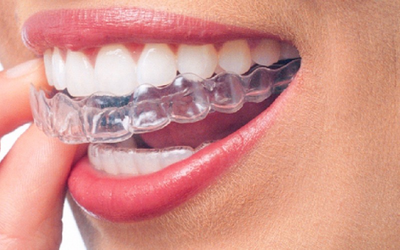 Niềng răng Invisalign - Phương pháp niềng răng khớp cắn sâu hiện đại