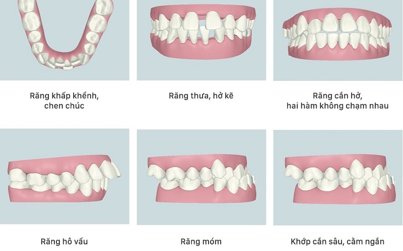 Các trường hợp răng lệch khớp cắn được khuyến khích niềng răng
