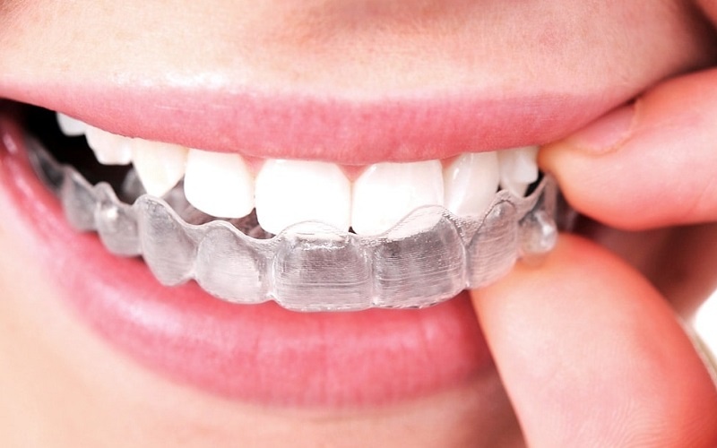 Niềng răng Invisalign - Phương pháp niềng răng lệch khớp cắn hiện đại 