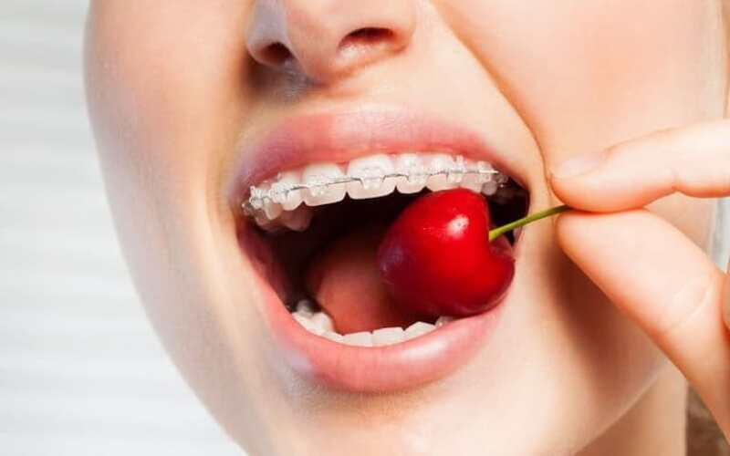 Niềng răng nên ăn gì là vấn đề được nhiều khách hàng quan tâm 