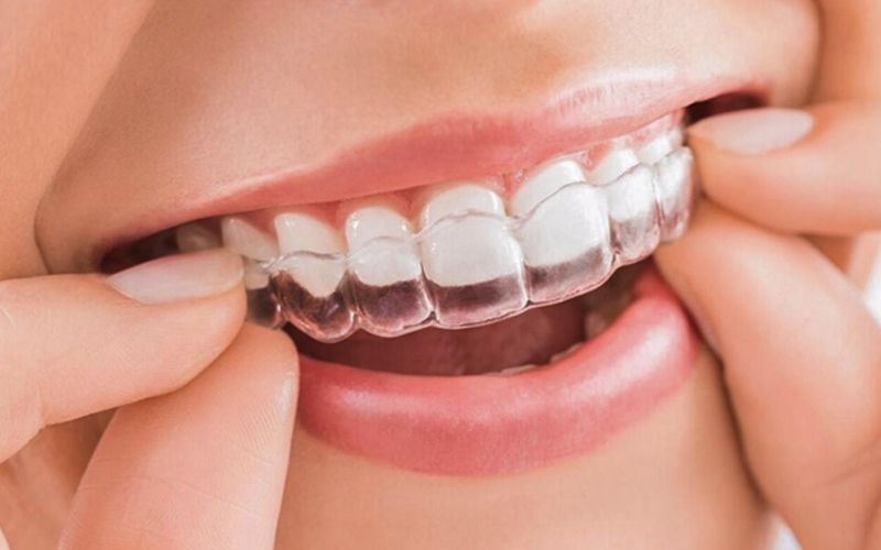 Niềng răng nhựa hay còn gọi là niềng răng vô hình hoặc chỉnh nha bằng khay trong suốt