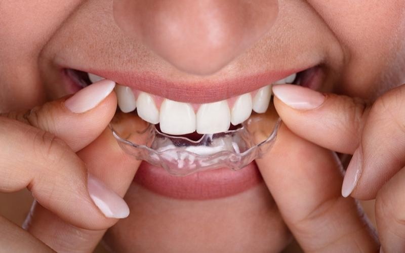 Niềng răng nhựa đảm bảo tính thẩm mỹ và tháo lắp dễ dàng