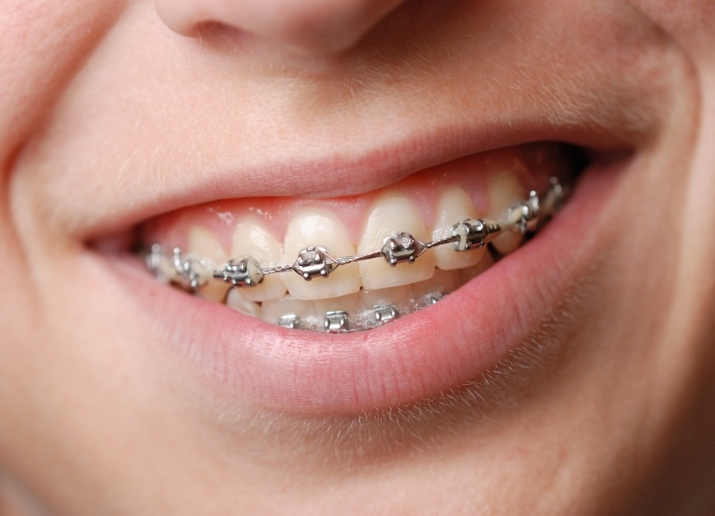 Niềng răng sắt giúp điều chỉnh các sai lệch răng hiệu quả